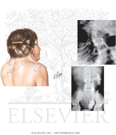 Klippel Feil Syndrome
