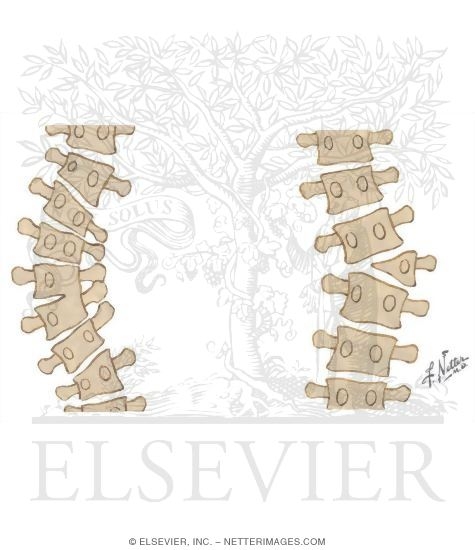 Watermarked preview of unlabeled image: Congenital Scoliosis