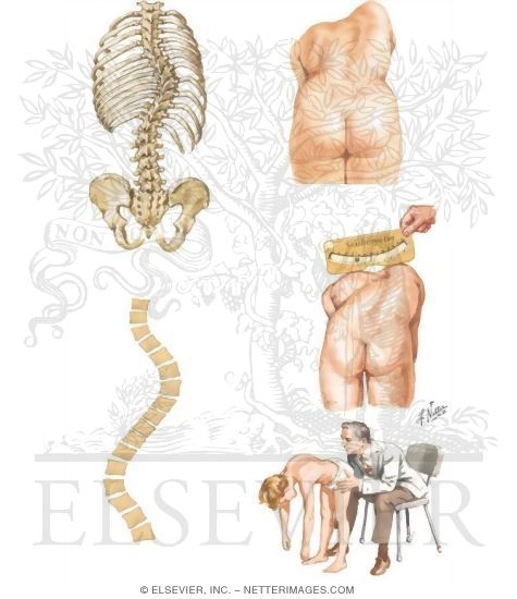 Watermarked preview of unlabeled image: Scoliosis