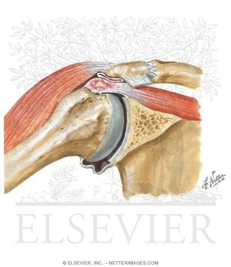 Watermarked preview of unlabeled image: Rotator Cuff Disease