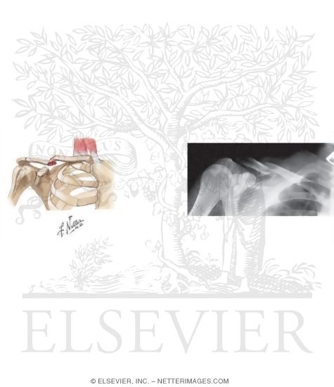 Fracture of the Clavicle