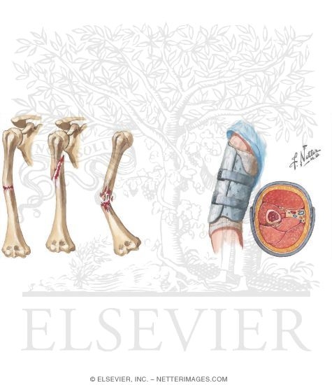 Fracture of Shaft of Humerus