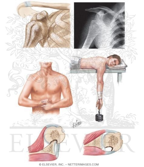Watermarked preview of unlabeled image: Anterior Dislocation, Glenohumeral Joint