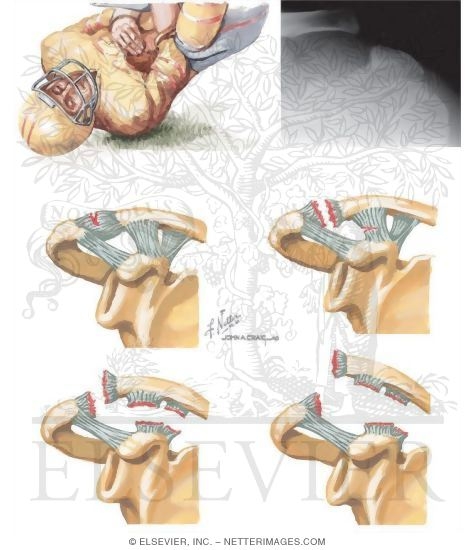 Watermarked preview of unlabeled image: Acromioclavicular Dislocation