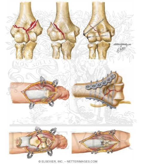 Watermarked preview of unlabeled image: Elbow Fractures