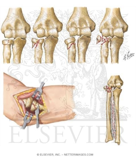 Watermarked preview of unlabeled image: Fracture of Head and Neck of Radius