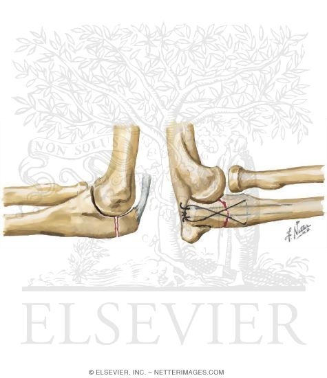 Olecranon Fracture