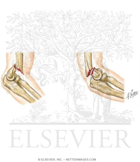 Supracondylar Fracture of the Humerus