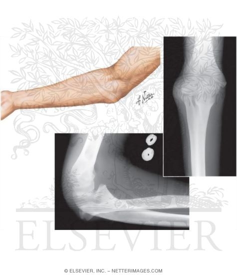 Congenital Dislocation of Radial Head