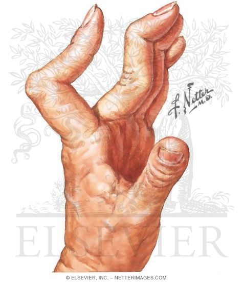Boutonniere and Swan-neck Deformity