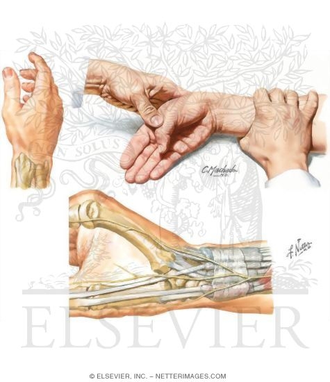 Watermarked preview of unlabeled image: De Quervain’s Disease