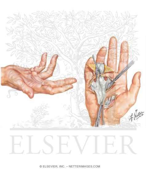Dupuytren Disease
