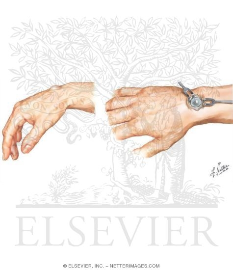 Watermarked preview of unlabeled image: Ganglion of Wrist