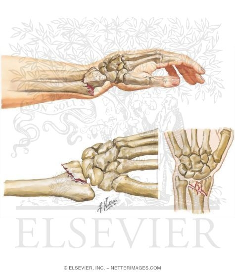Watermarked preview of unlabeled image: Fractures of the Distal Radius