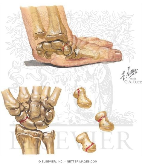 Fracture of Scaphoid