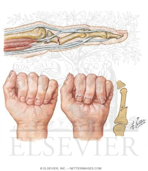 Fracture of Proximal Phalynx