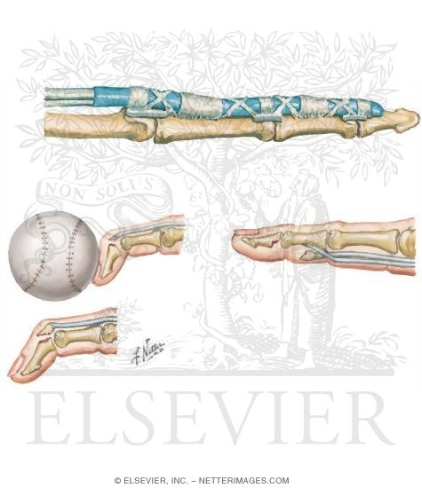 Flexor Tendon Anatomy and Injuries