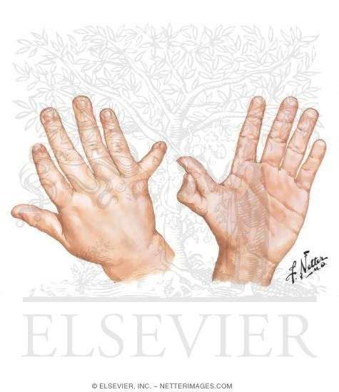 Watermarked preview of unlabeled image: Polydactyly