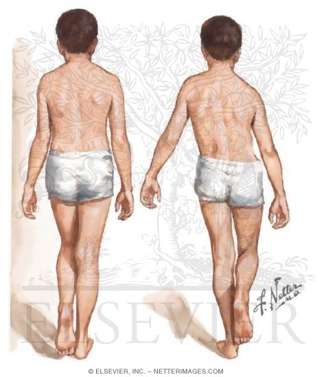 Trendelenberg Test