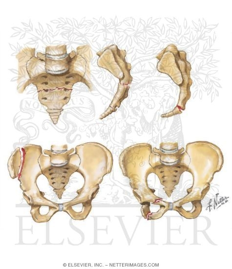 Watermarked preview of unlabeled image: Stable Pelvic Ring Fractures