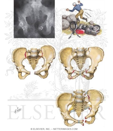 Unstable Pelvic Fractures