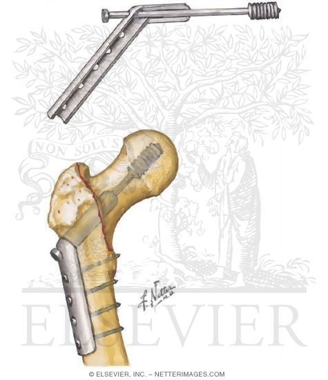 Watermarked preview of unlabeled image: Intertrochanteric Fracture of Femur