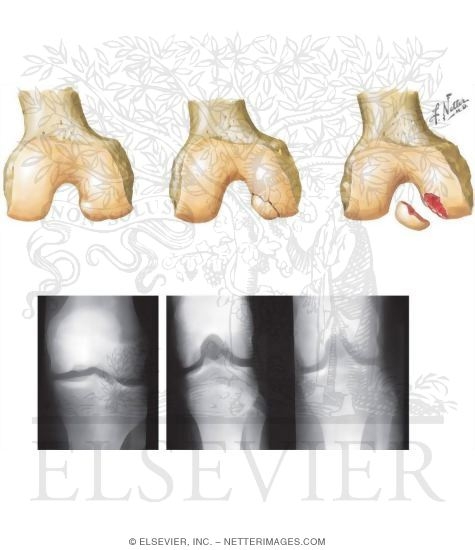 Watermarked preview of unlabeled image: Progression of Osteochondritis Dissecans
