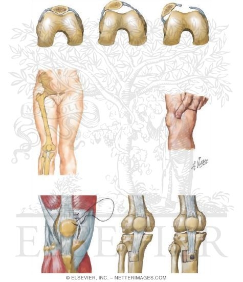 Subluxation and Dislocation of Patella