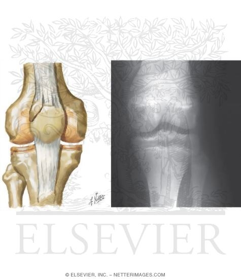Bipartite Patella