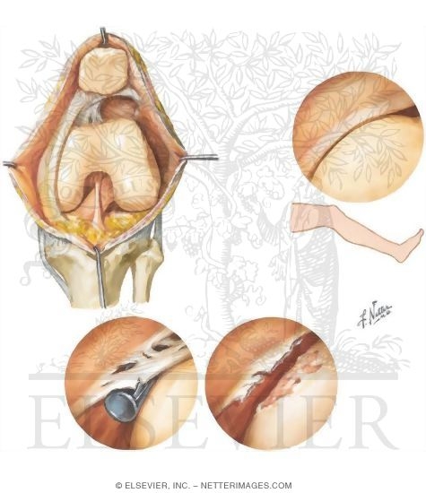 Watermarked preview of unlabeled image: Synovial Plica