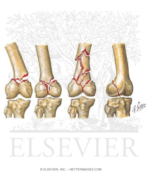 Fracture of Distal Femur