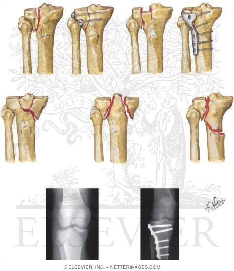 Tibial Plateau Fractures