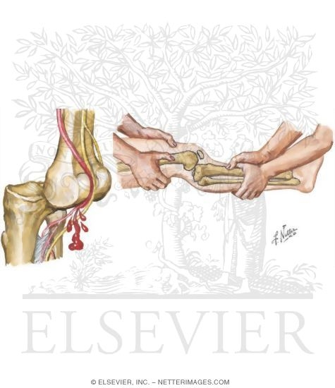 Watermarked preview of unlabeled image: Dislocation of the Knee