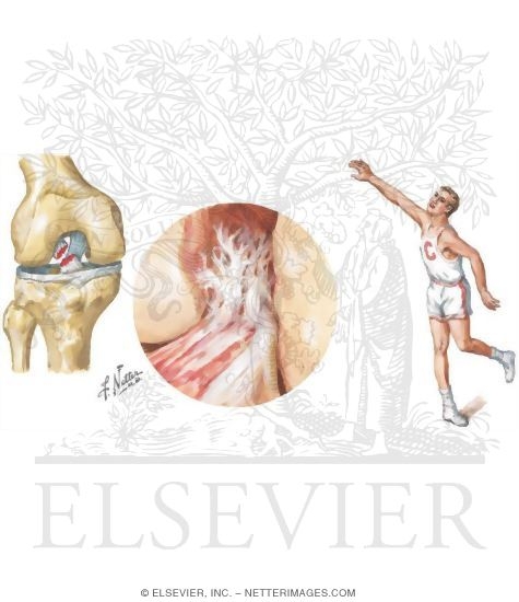 Rupture of the Anterior Cruciate Ligament