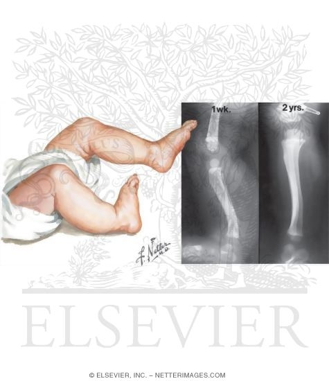 Posteromedial Bowing of the Tibia