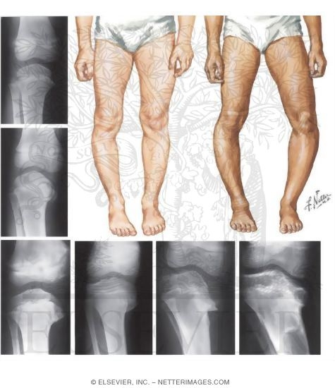 Infantile Tibia Vara