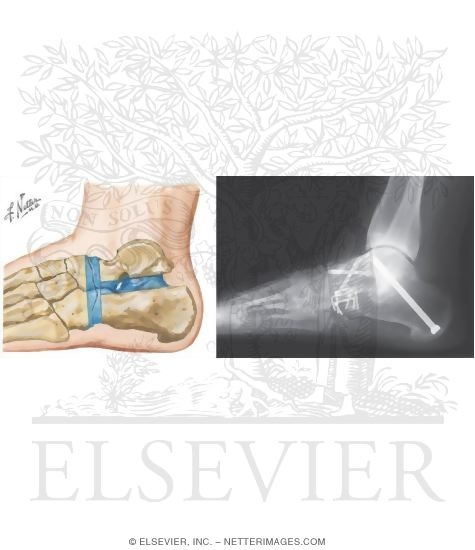 Watermarked preview of unlabeled image: Triple Arthrodesis