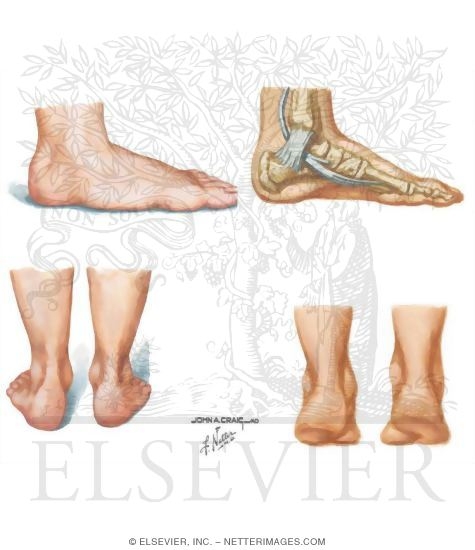 Watermarked preview of unlabeled image: Posterior Tibial Dysfunction