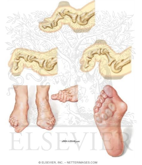 Lesser Toe Deformities (Claw Toe, Hammertoe, and Mallet Toe)