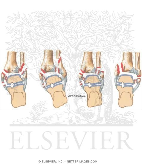 Lauge-Hansen Classification of Ankle Fracture