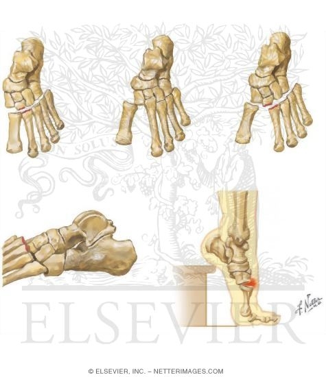 Injury to Tarsometatarsal (Lisfranc) Joint Complex
