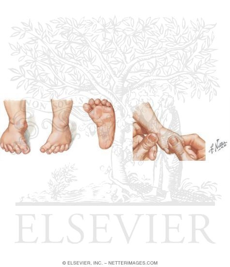 Watermarked preview of unlabeled image: Metatarsus Adductus