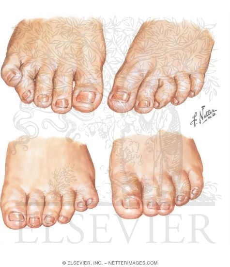 Polydactyly, Syndactyly, Congenital Curly Toe, and Overlapping Fifth Toe