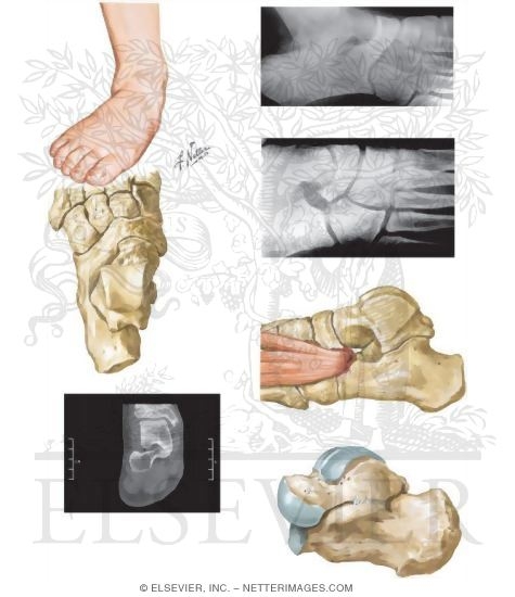 Watermarked preview of unlabeled image: Tarsal Coalition