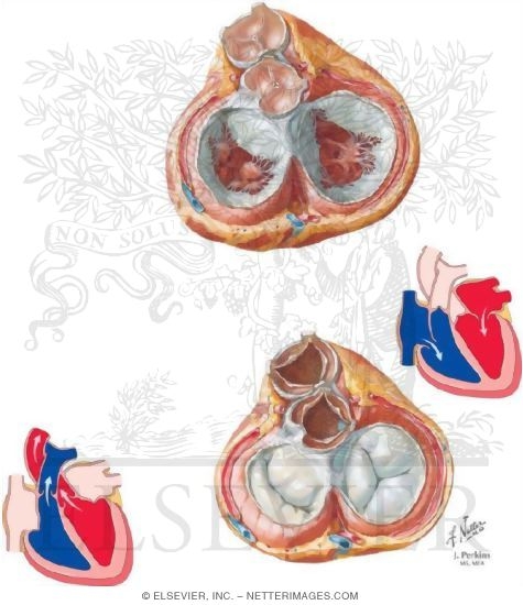Heart Valves