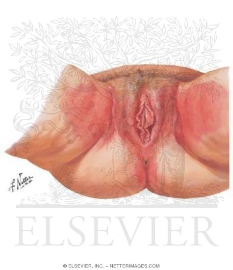 Contact Vulvitis