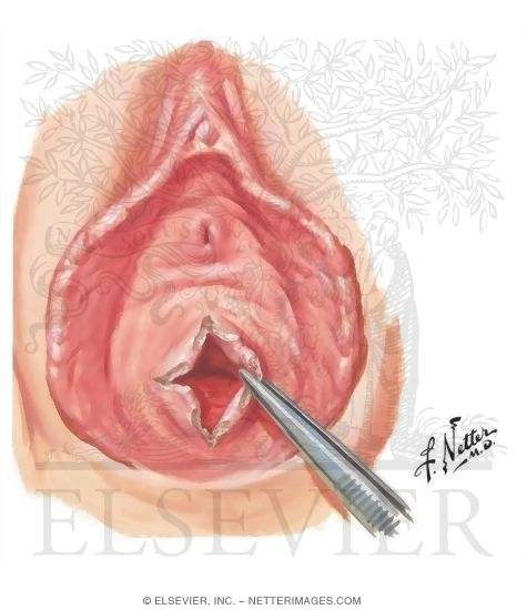 Hymenal Stenosis