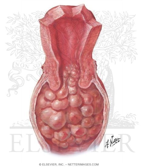 Sarcoma Botryoides