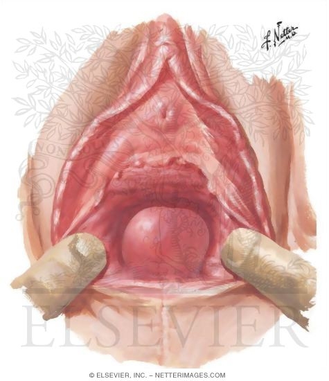 Inclusion Cyst