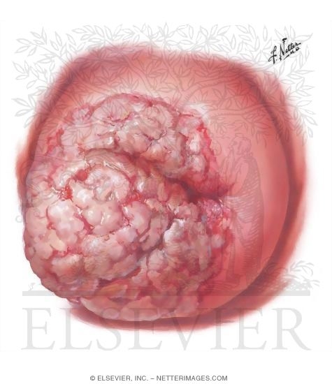 Cervical Cancer